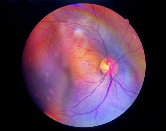 diabeticka retinopatia