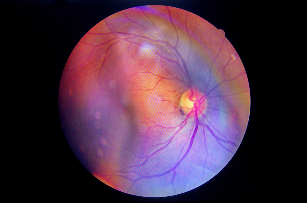 diabeticka retinopatia
